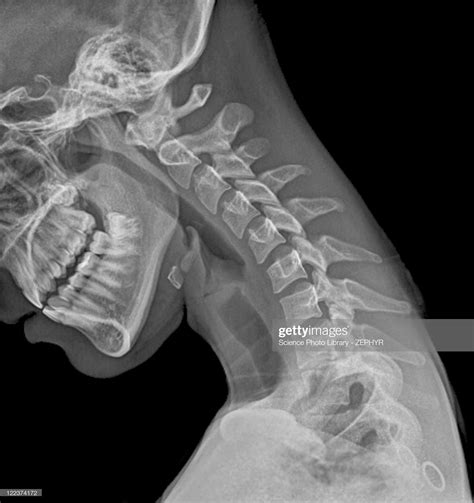 Normal flexed neck. X-ray of the flexed cervical spine of a 20 year... | Xray art, X ray, Human body