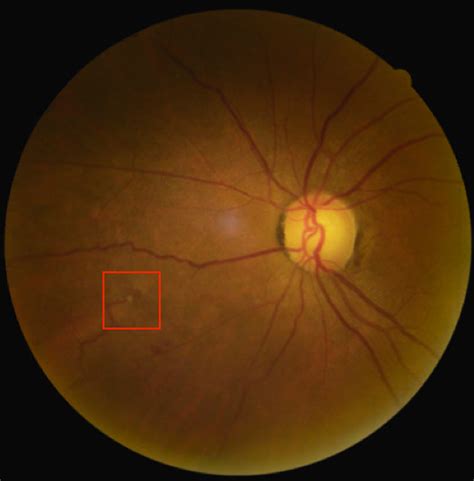 Retinal Hemorrhage