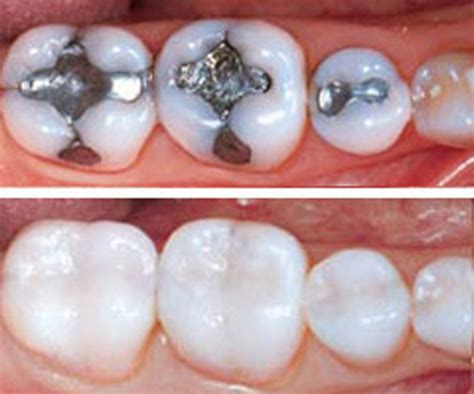 Tooth Colored Fillings | Services | SPS Dental | Kenosha, WI