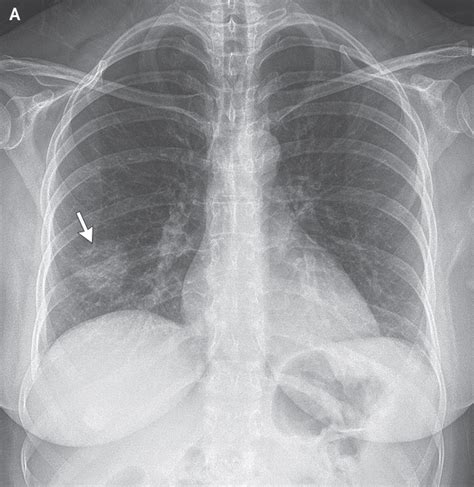 A Woman with a Lung Mass | NEJM Resident 360