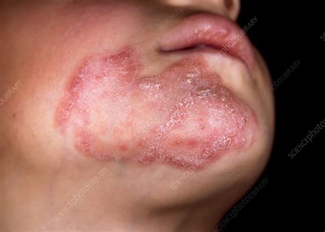 Tinea fungal face infection - Stock Image - C036/4844 - Science Photo ...