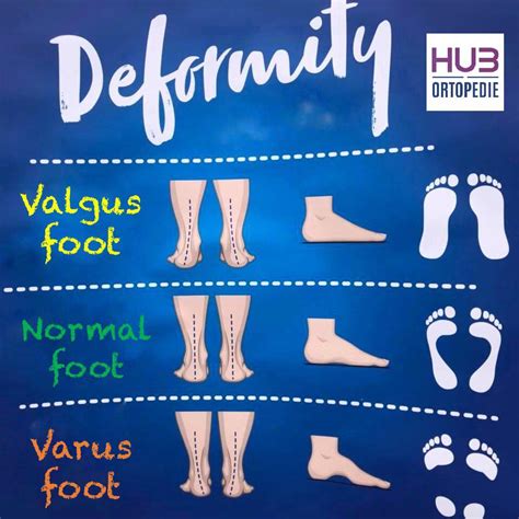 Many people suffer from foot... - HUB Ortopedie.MD