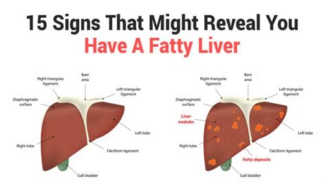 15 Signs That Might Reveal You Have A Fatty Liver| 6 Minute Read