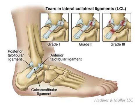 Ankle Sprain Grades