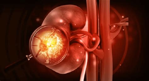 Kidney Abscess (Renal Abscess) Symptoms in 2022 | Kidney, Kidney disease, Renal