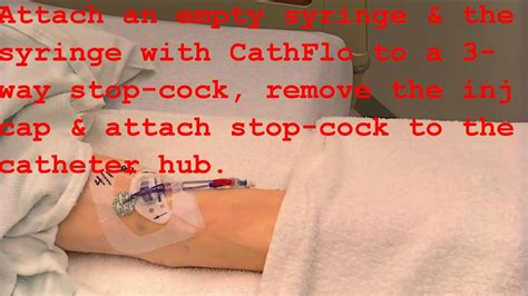 Declotting with CathFlo - YouTube