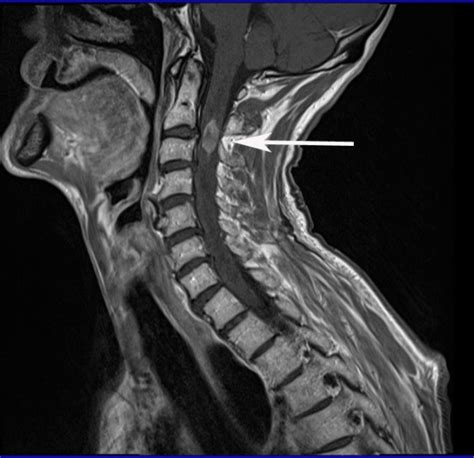 Sagittal T1-weighted MRI of his cervical spine. | Download Scientific Diagram