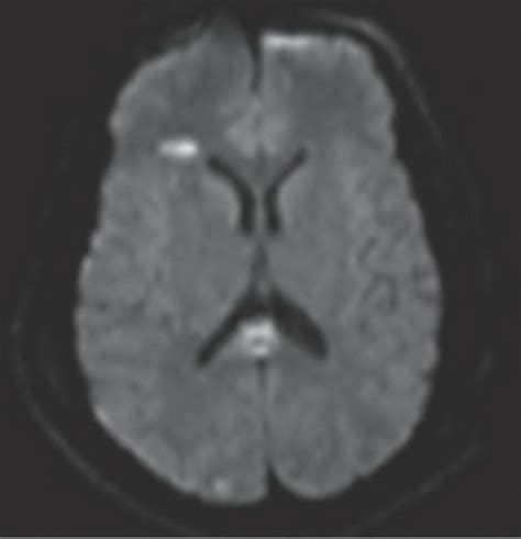 Diffuse Axonal Injury | Radiology Key