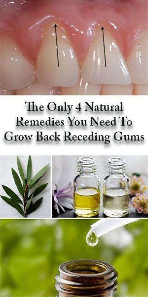 The Only 4 Natural Remedies You Need To Grow Back Receding Gums - Jonathanblog | Grow back ...