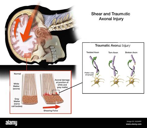 Traumatic brain injury hi-res stock photography and images - Alamy