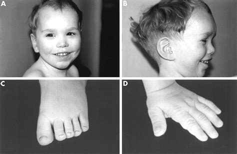 Dysmorphism, variable overgrowth, normal bone age, and severe developmental delay: a “Sotos-like ...