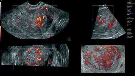 [View 32+] Uterine Cancer Ultrasound Endometrial Hyperplasia | KeTTHA