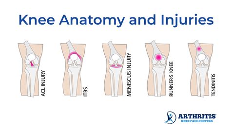 Knee Pain Location Chart | Arthritis Knee Pain Centers