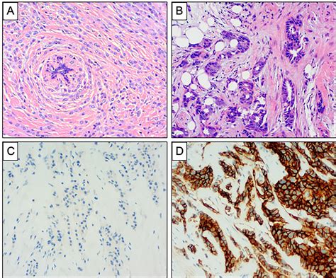 Frontiers | Lobular Breast Cancer: A Review