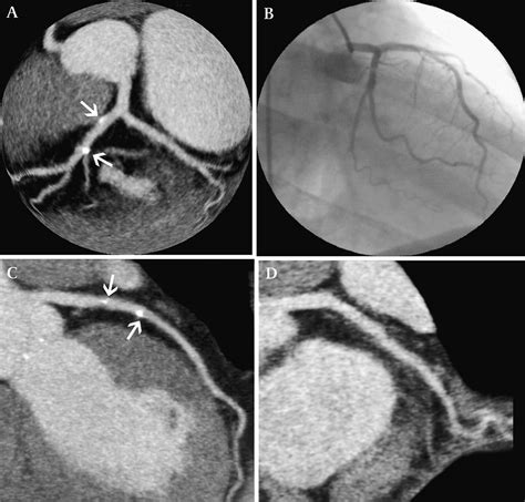 Thyroid Ultrasound: Enlarged Heterogeneous Thyroid Ultrasound