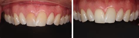 Collaroy Dental | Before & After Gallery | Tooth Bleaching Cases