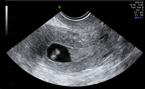 Uterine Cancer Ultrasound Images