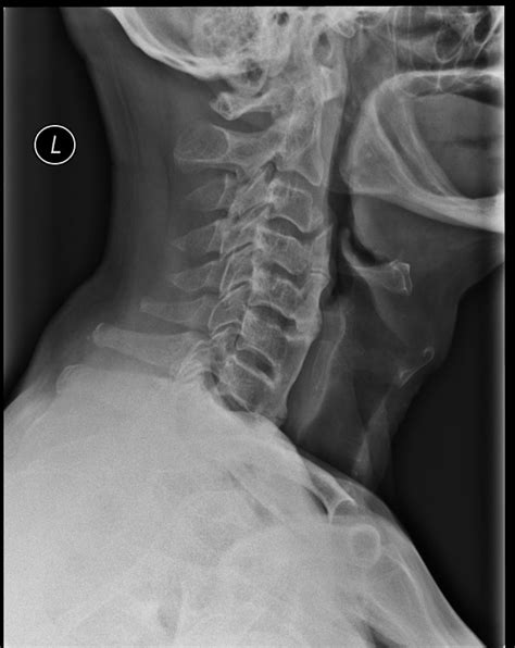 Diffuse Idiopathic Skeletal Hyperostosis Cervical Spine