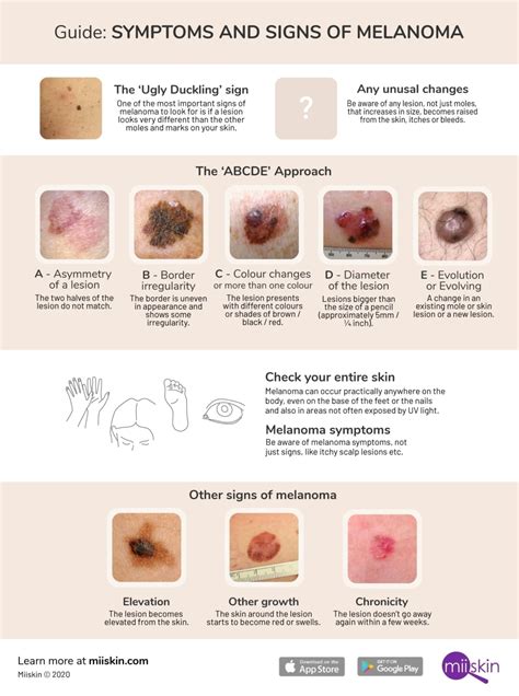 Melanoma Symptoms and Signs: Extensive Guide