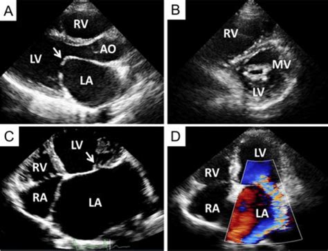 Transthoracic echocardiography from a patient with severe mitral ...