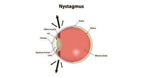 Nystagmus - Denver Youth Dental & Vision