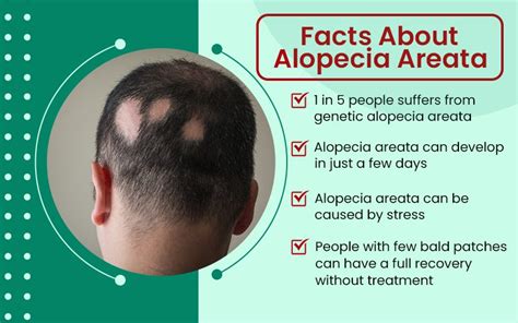 Alopecia Areata Treatment