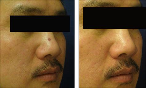 Laser Mole Removal in Chicago: Before and After Photos