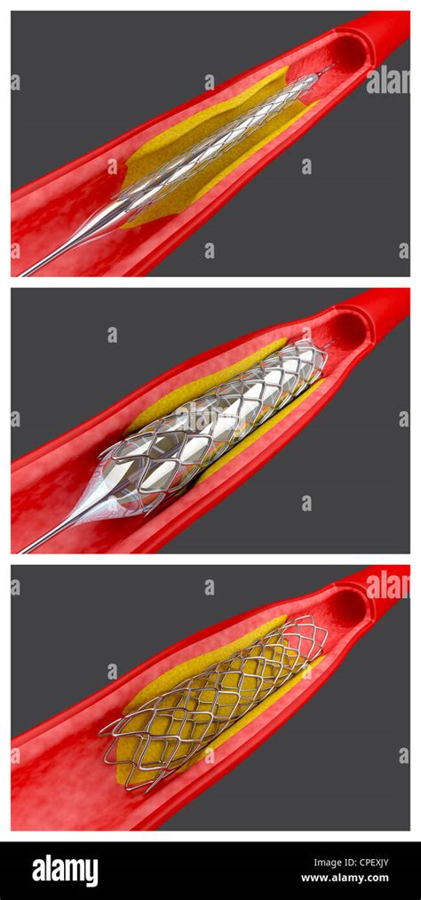 Balloon angioplasty procedure with placing a stent Stock Photo - Alamy