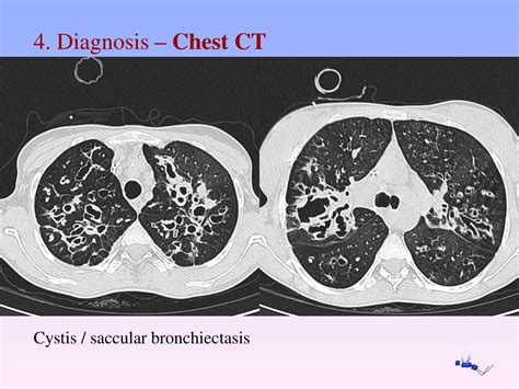 Mild Cylindrical Bronchiectasis: Comprehensive Guide to Treatment, Symptoms, and Prognosis