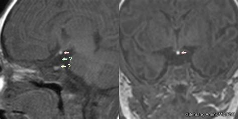 Roentgen Ray Reader: Pituitary Dwarfism