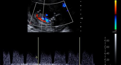 Doppler ultrasound scans in pregnancy - BabyCenter India