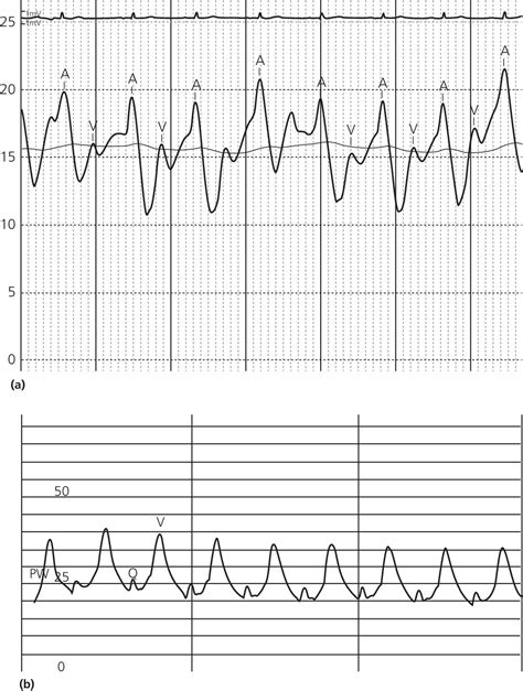 5: The atrial waveform | Thoracic Key