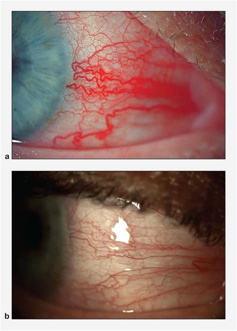 Scleritis and episcleritis - American Academy of Ophthalmology