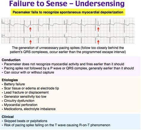 emDOCs.net – Emergency Medicine EducationEM@3AM: Pacemaker/AICD ...