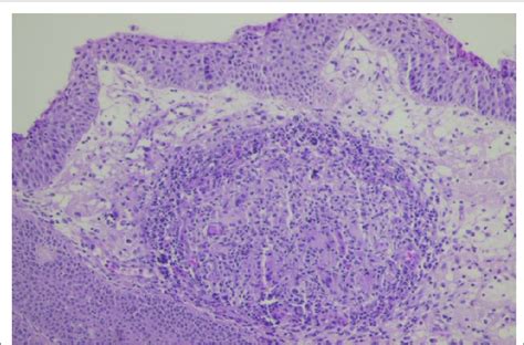 Histopathological examination of nasal mucosa biopsies showed ...