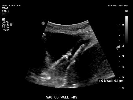 Ventriculogallbladder shunt | Radiology Reference Article | Radiopaedia.org