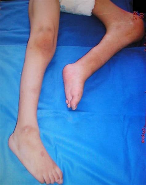 Flexion Contracture