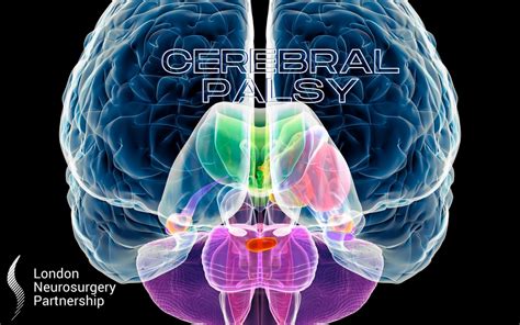 Cerebral palsy - London Neurosurgery - Spine & Neurosurgery