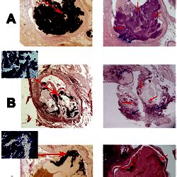 Histology of aortic valves.