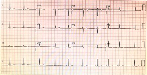 Electrocardiogram (ECG) showing sinus arrhythmia, borderline T ...