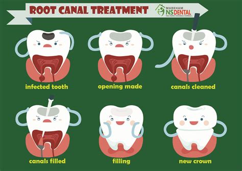 Free Root Canal Cliparts, Download Free Root Canal Cliparts png images, Free ClipArts on Clipart ...