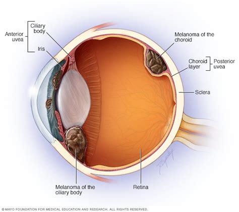 Eye melanoma Disease Reference Guide - Drugs.com