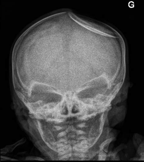 Massive congenital depression of neonate’s skull | ADC Fetal & Neonatal ...