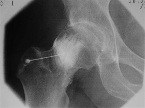 6. Fluoroscopic image of intra-articular hip injection (courtesy of Dr.... | Download Scientific ...