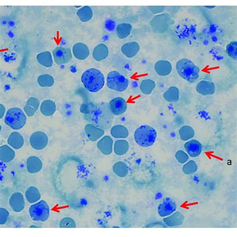 | Peripheral Blood Smear, May Grunwald Giemsa Stain. (a) Transfused red... | Download Scientific ...