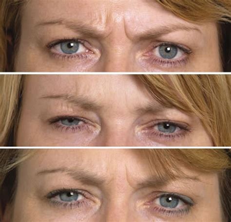 Want To Eradicate Brow Wrinkles Quickly And Without Botox? Carry Out These Facial Aerobics ...