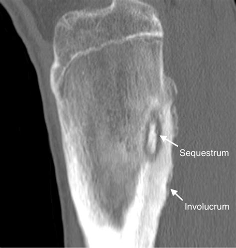 [Figure, Chronic Osteomyelitis, Computed Tomography. This...] - StatPearls - NCBI Bookshelf