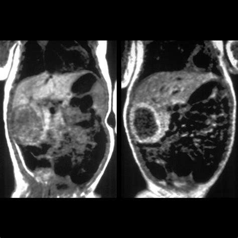 Pediatric Hepatic Hemangioma | Pediatric Radiology Reference Article | Pediatric Imaging ...