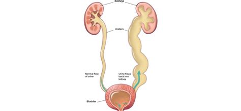 Vesicoureteral reflux – Healthy Food Near Me