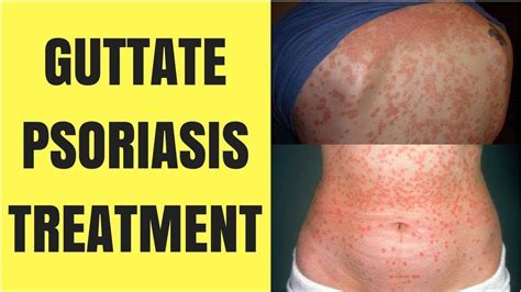 Home Remedies for Guttate Psoriasis - YouTube